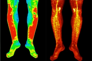 Scans of legs showing disease