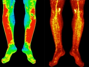 Scans of legs showing disease