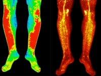 Scans of legs showing disease